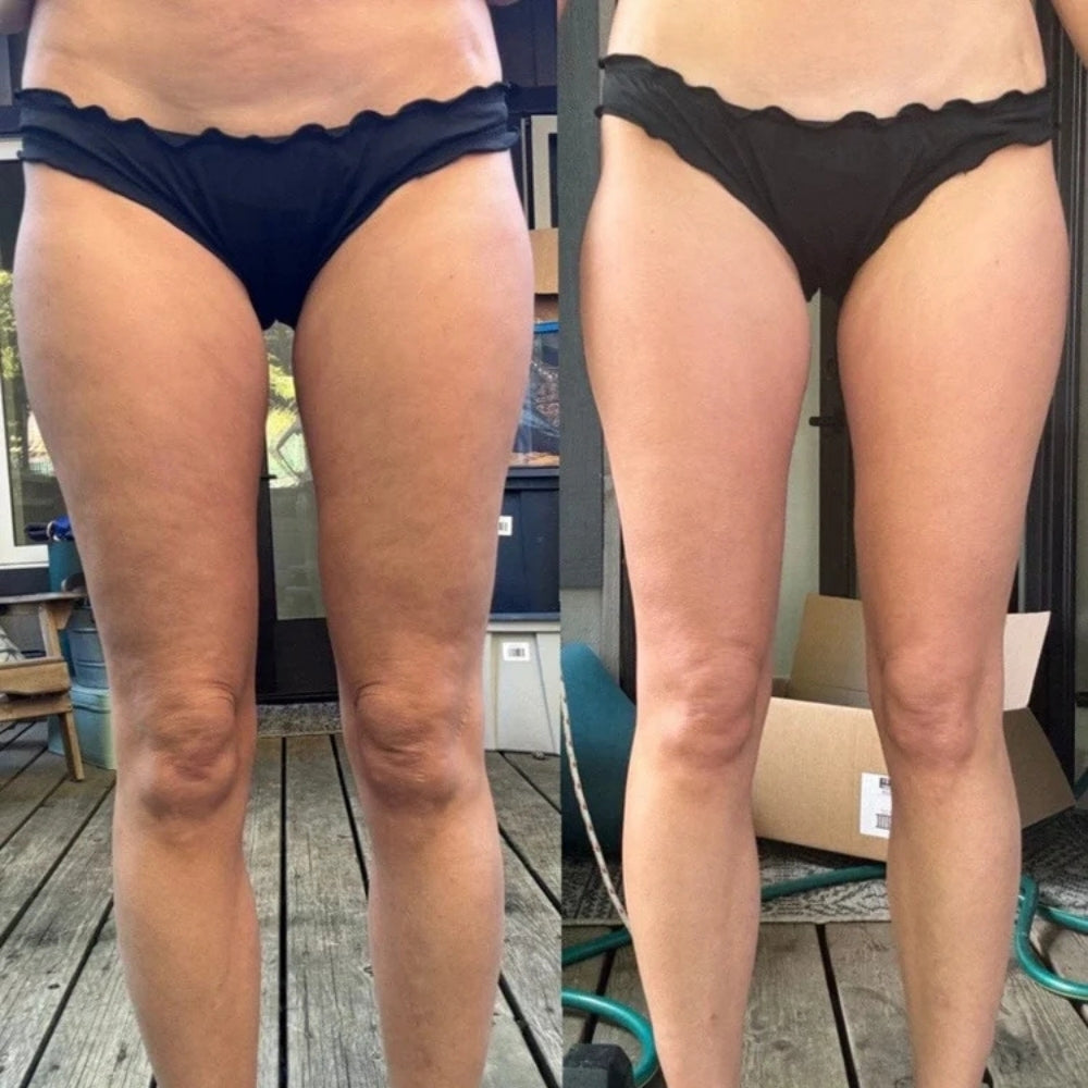 Glamoara™ - Anti-Cellulite Massager